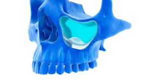 상악동 거상술의 해부학적 구조와 임플란트 식립 원리 3D 일러스트