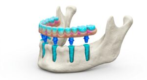 전체 임플란트의 구조적 원리를 보여주는 3D 의학 일러스트